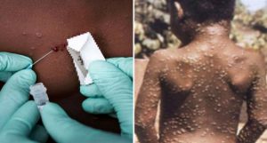 trieu-chung-cua-benh-dau-mua-khi-1