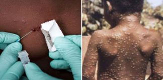 trieu-chung-cua-benh-dau-mua-khi-1