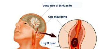 dau-hieu-nhan-biet-nhanh-nguoi-bi-dot-quy-1