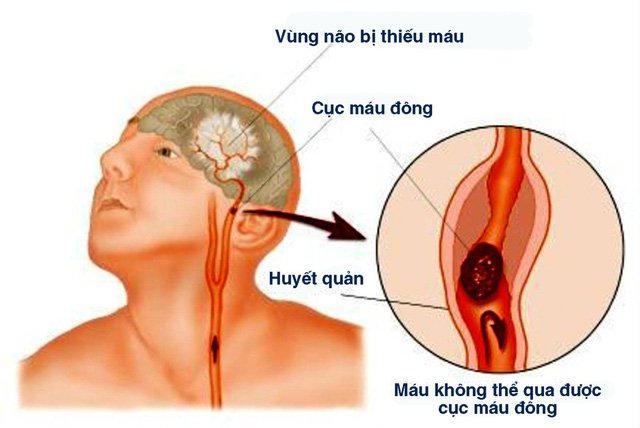 dau-hieu-nhan-biet-nhanh-nguoi-bi-dot-quy-1