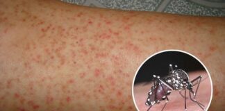 nhung-dieu-can-biet-khi-cham-soc-nguoi-benh-sot-xuat-huyet-1